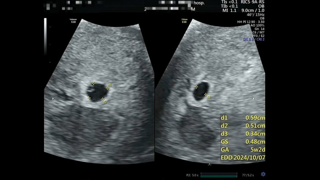 임신초기-절박유산